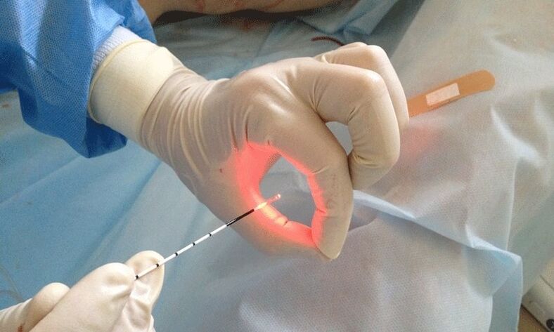 Laser treatment for prostatitis