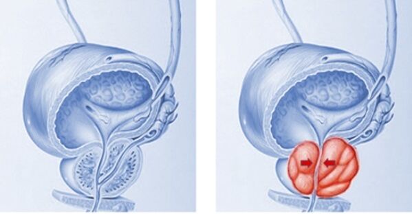 A healthy and inflamed prostate (with prostatitis)